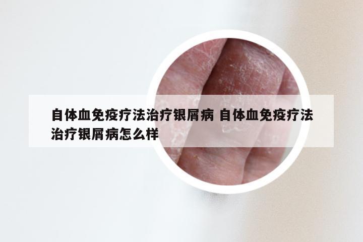 自体血免疫疗法治疗银屑病 自体血免疫疗法治疗银屑病怎么样