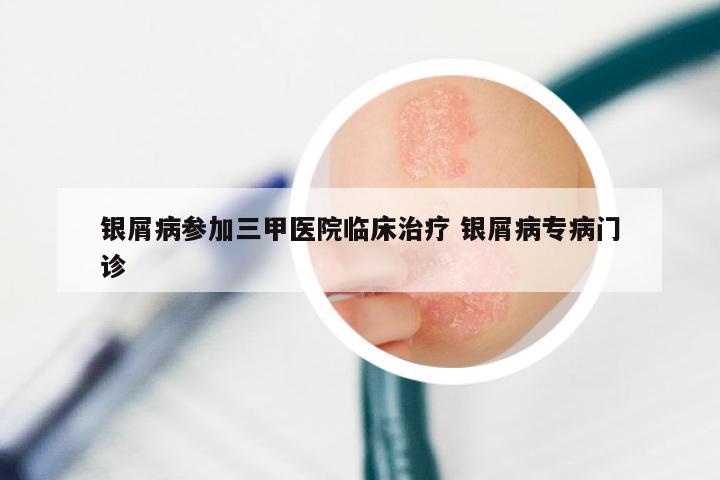 银屑病参加三甲医院临床治疗 银屑病专病门诊