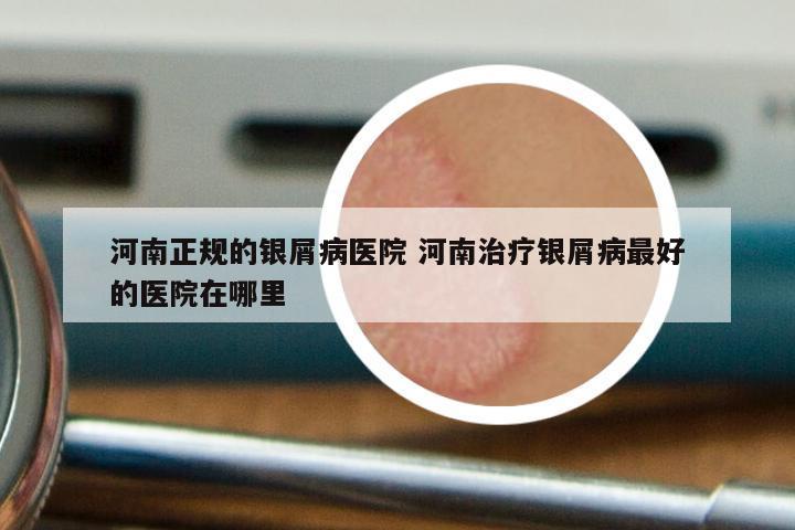 河南正规的银屑病医院 河南治疗银屑病最好的医院在哪里