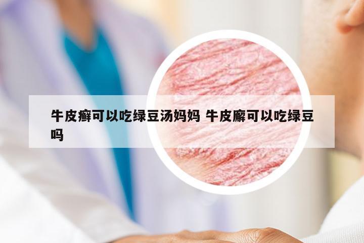 牛皮癣可以吃绿豆汤妈妈 牛皮廨可以吃绿豆吗