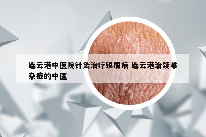 连云港中医院针灸治疗银屑病 连云港治疑难杂症的中医