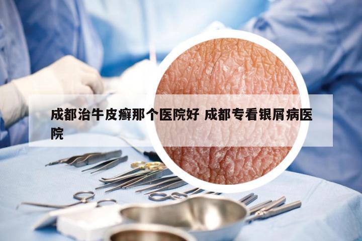 成都治牛皮癣那个医院好 成都专看银屑病医院