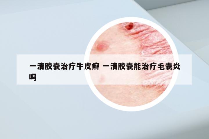 一清胶囊治疗牛皮癣 一清胶囊能治疗毛囊炎吗
