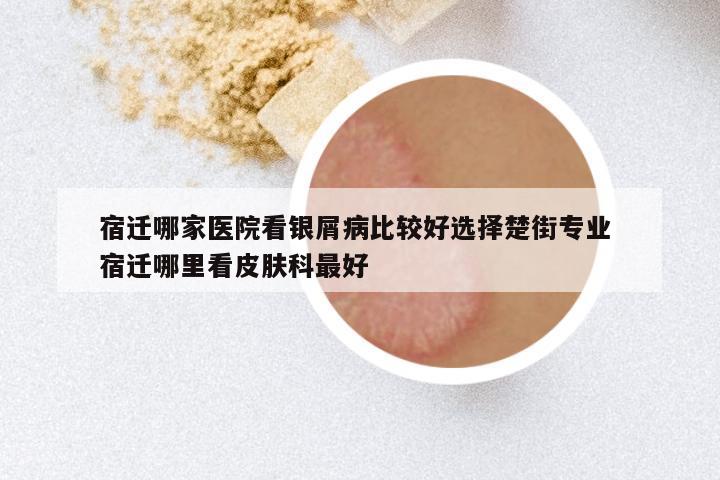 宿迁哪家医院看银屑病比较好选择楚街专业 宿迁哪里看皮肤科最好