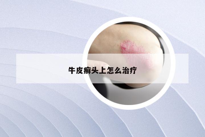 牛皮癣头上怎么治疗