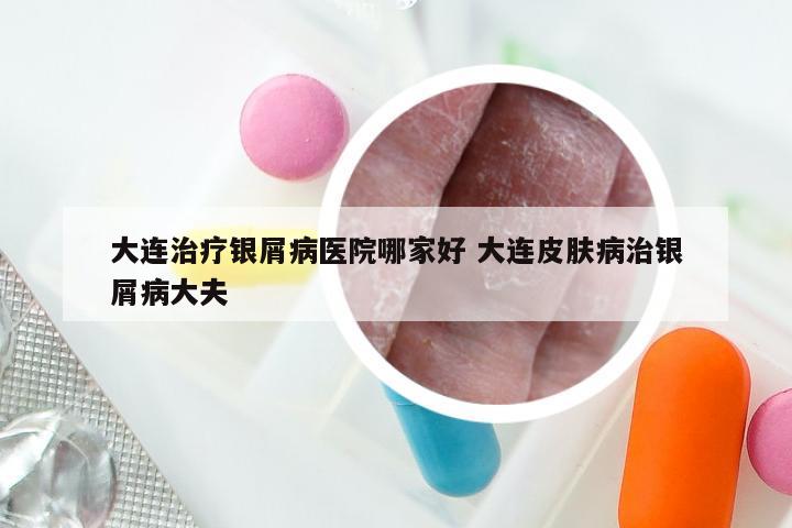 大连治疗银屑病医院哪家好 大连皮肤病治银屑病大夫
