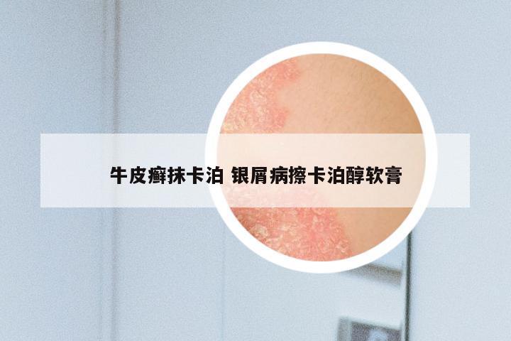 牛皮癣抹卡泊 银屑病擦卡泊醇软膏