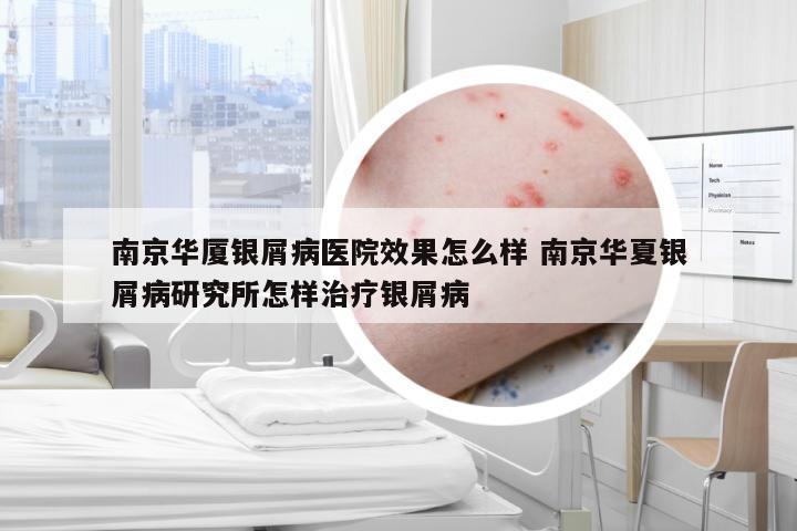 南京华厦银屑病医院效果怎么样 南京华夏银屑病研究所怎样治疗银屑病
