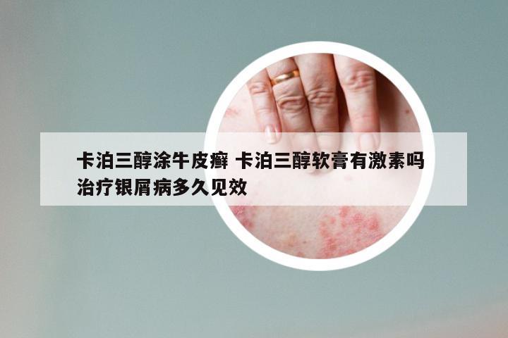卡泊三醇涂牛皮癣 卡泊三醇软膏有激素吗 治疗银屑病多久见效