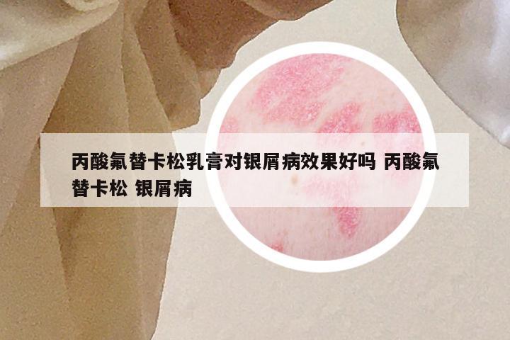 丙酸氟替卡松乳膏对银屑病效果好吗 丙酸氟替卡松 银屑病