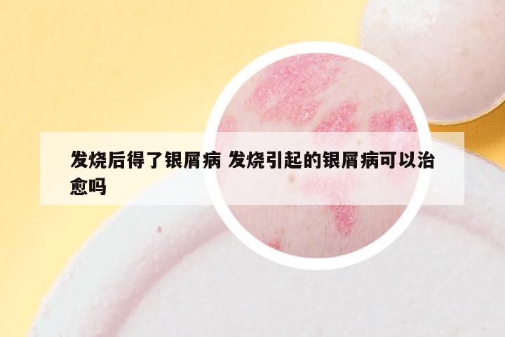 发烧后得了银屑病 发烧引起的银屑病可以治愈吗