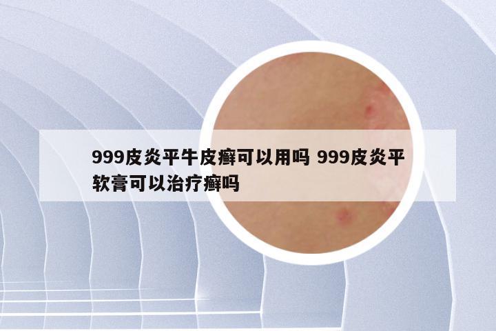 999皮炎平牛皮癣可以用吗 999皮炎平软膏可以治疗癣吗
