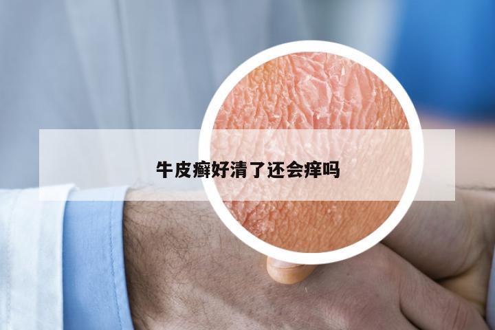 牛皮癣好清了还会痒吗