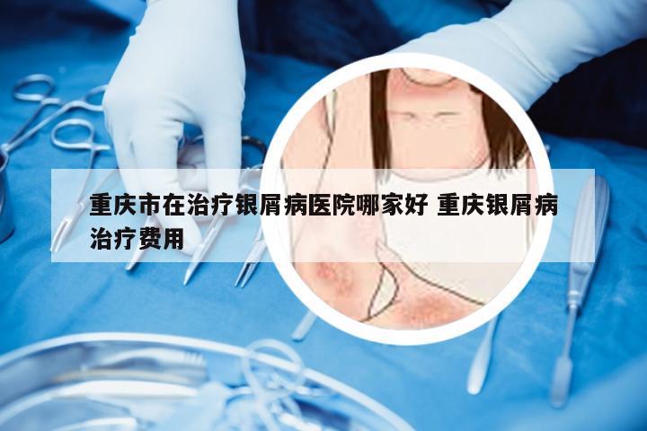 重庆市在治疗银屑病医院哪家好 重庆银屑病治疗费用