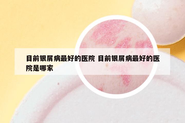 目前银屑病最好的医院 目前银屑病最好的医院是哪家