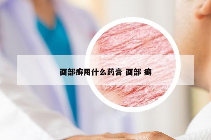 面部癣用什么药膏 面部 癣