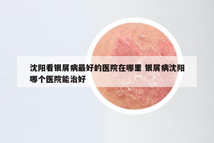 沈阳看银屑病最好的医院在哪里 银屑病沈阳哪个医院能治好