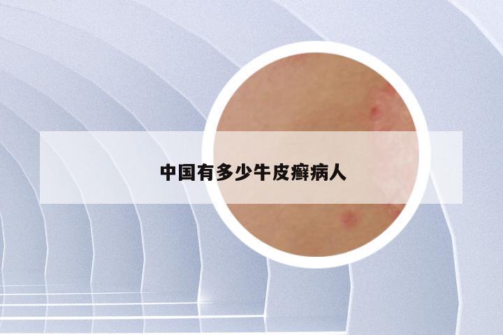 中国有多少牛皮癣病人