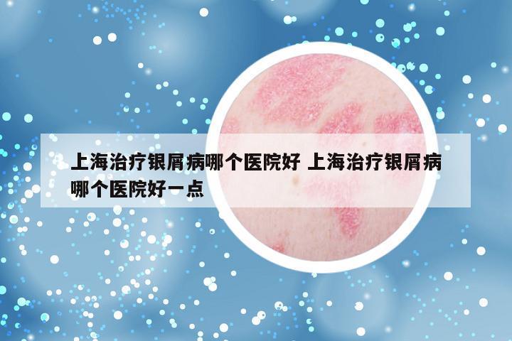 上海治疗银屑病哪个医院好 上海治疗银屑病哪个医院好一点