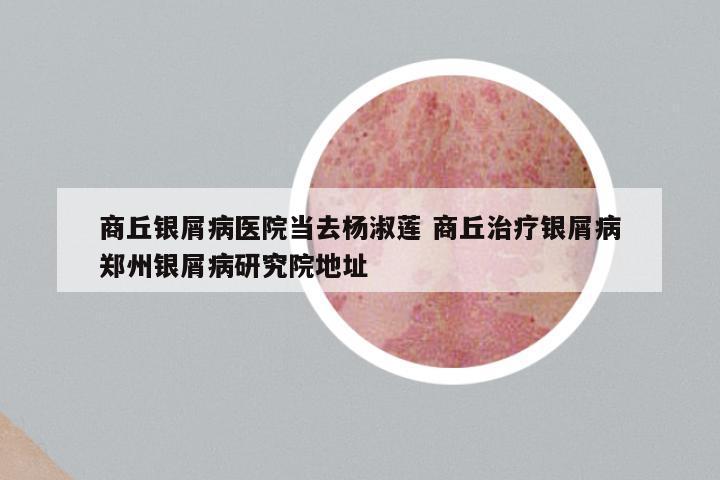商丘银屑病医院当去杨淑莲 商丘治疗银屑病郑州银屑病研究院地址