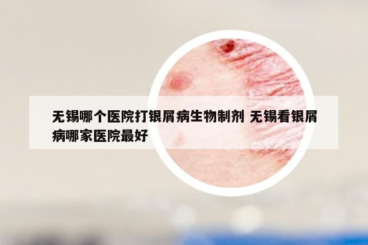 无锡哪个医院打银屑病生物制剂 无锡看银屑病哪家医院最好