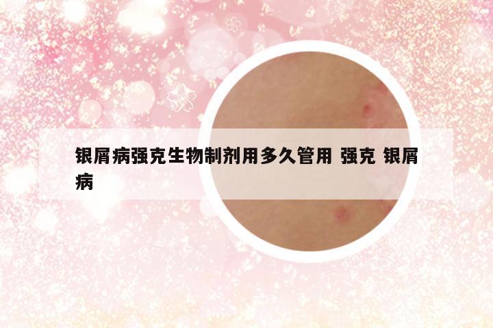 银屑病强克生物制剂用多久管用 强克 银屑病