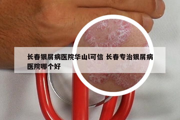 长春银屑病医院华山l可信 长春专治银屑病医院哪个好