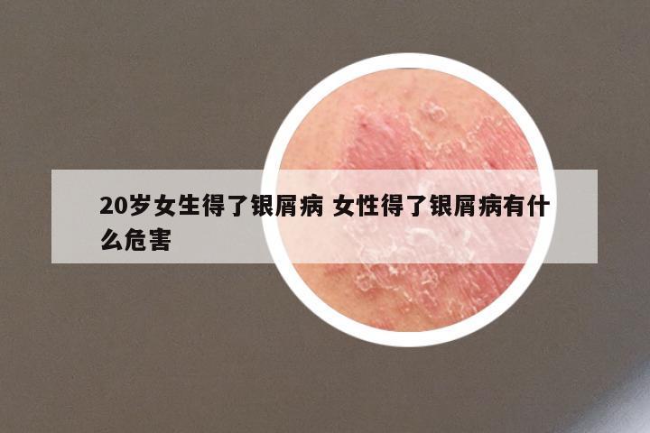 20岁女生得了银屑病 女性得了银屑病有什么危害