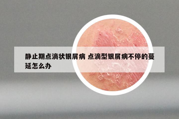 静止期点滴状银屑病 点滴型银屑病不停的蔓延怎么办