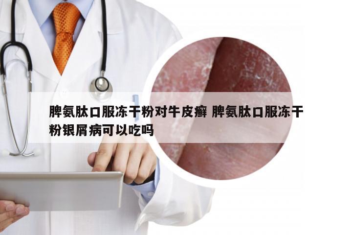 脾氨肽口服冻干粉对牛皮癣 脾氨肽口服冻干粉银屑病可以吃吗