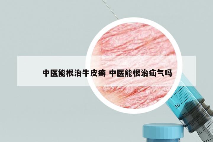 中医能根治牛皮癣 中医能根治疝气吗