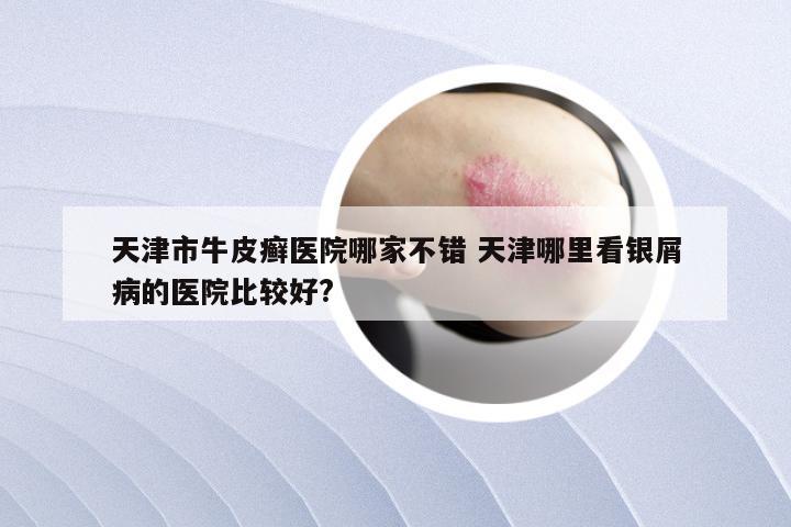 天津市牛皮癣医院哪家不错 天津哪里看银屑病的医院比较好?