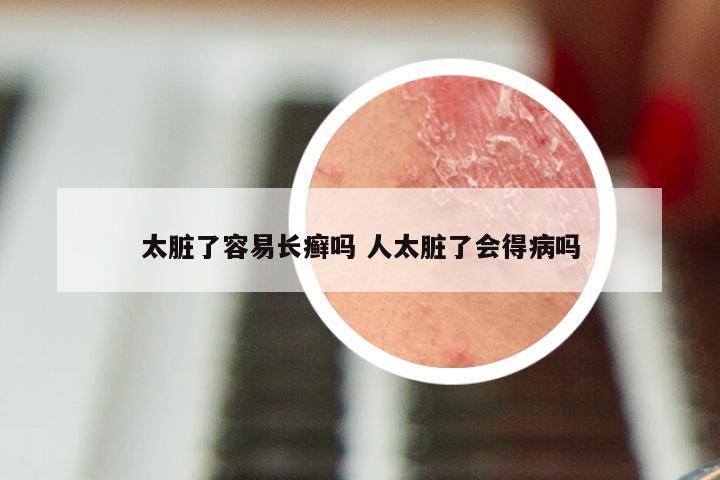 太脏了容易长癣吗 人太脏了会得病吗