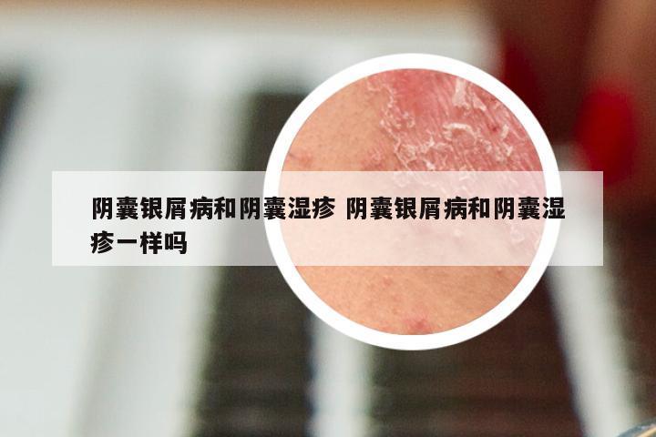 阴囊银屑病和阴囊湿疹 阴囊银屑病和阴囊湿疹一样吗