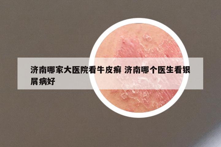 济南哪家大医院看牛皮癣 济南哪个医生看银屑病好