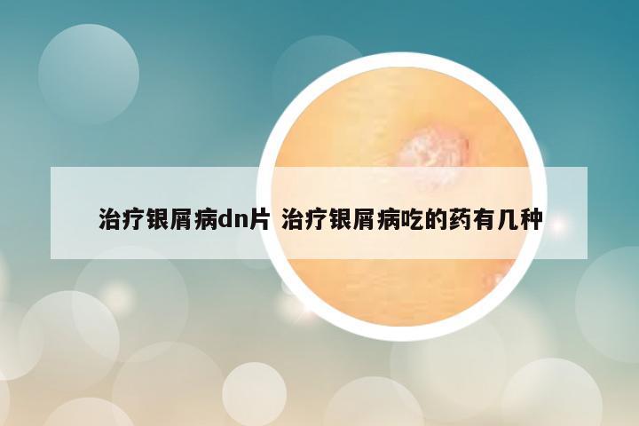 治疗银屑病dn片 治疗银屑病吃的药有几种