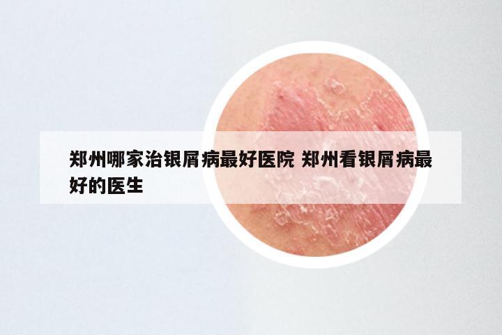 郑州哪家治银屑病最好医院 郑州看银屑病最好的医生
