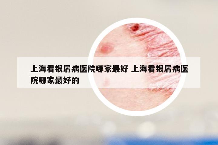 上海看银屑病医院哪家最好 上海看银屑病医院哪家最好的