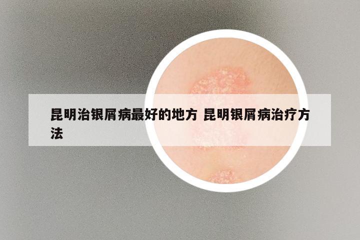 昆明治银屑病最好的地方 昆明银屑病治疗方法