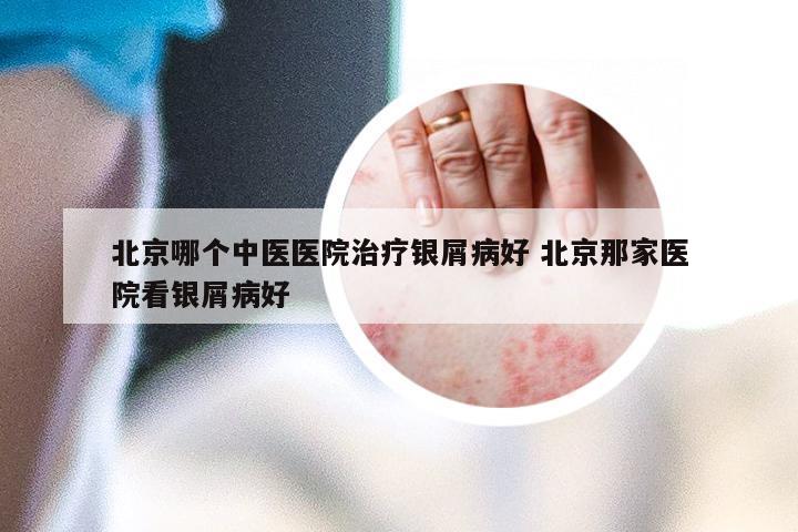 北京哪个中医医院治疗银屑病好 北京那家医院看银屑病好