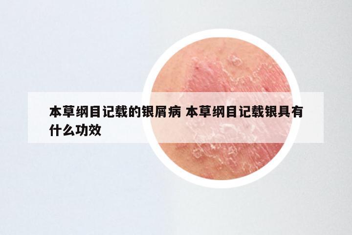 本草纲目记载的银屑病 本草纲目记载银具有什么功效