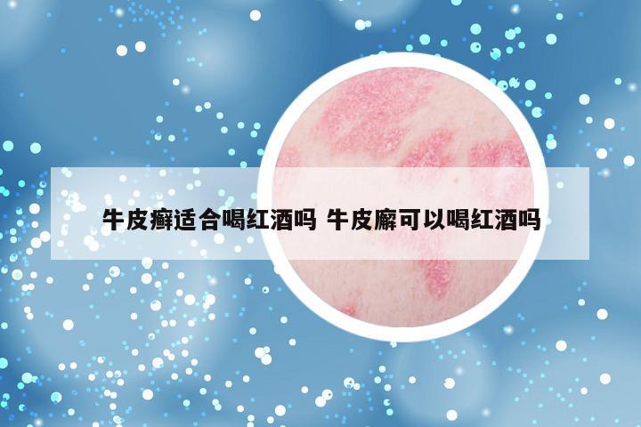 牛皮癣适合喝红酒吗 牛皮廨可以喝红酒吗