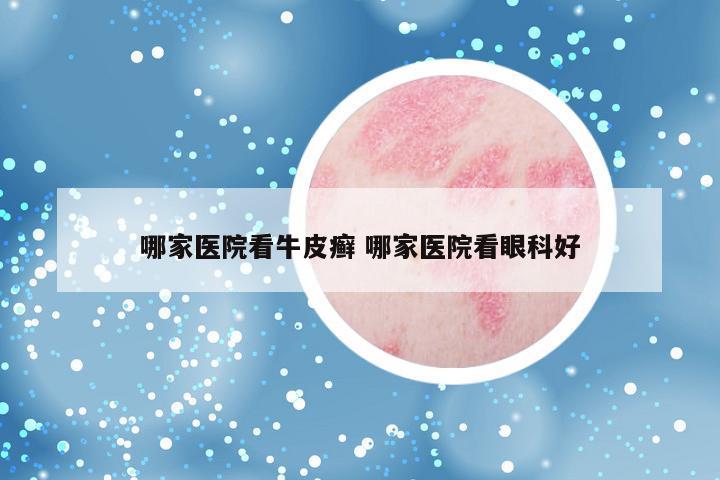 哪家医院看牛皮癣 哪家医院看眼科好