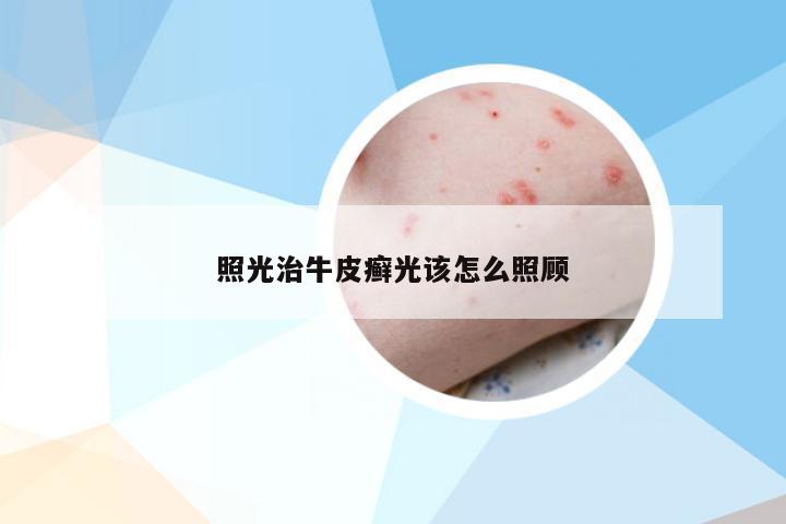 照光治牛皮癣光该怎么照顾
