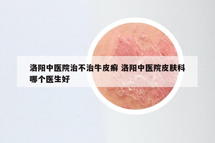 洛阳中医院治不治牛皮癣 洛阳中医院皮肤科哪个医生好
