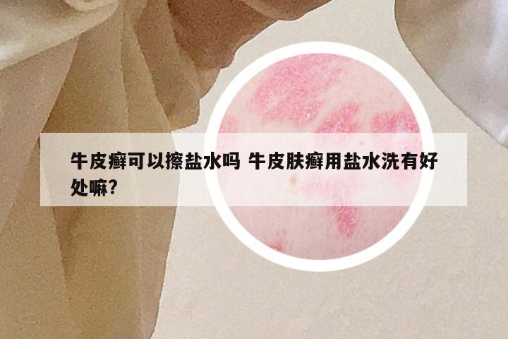 牛皮癣可以擦盐水吗 牛皮肤癣用盐水洗有好处嘛?