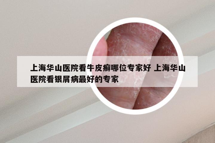 上海华山医院看牛皮癣哪位专家好 上海华山医院看银屑病最好的专家