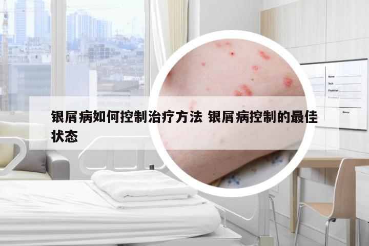 银屑病如何控制治疗方法 银屑病控制的最佳状态