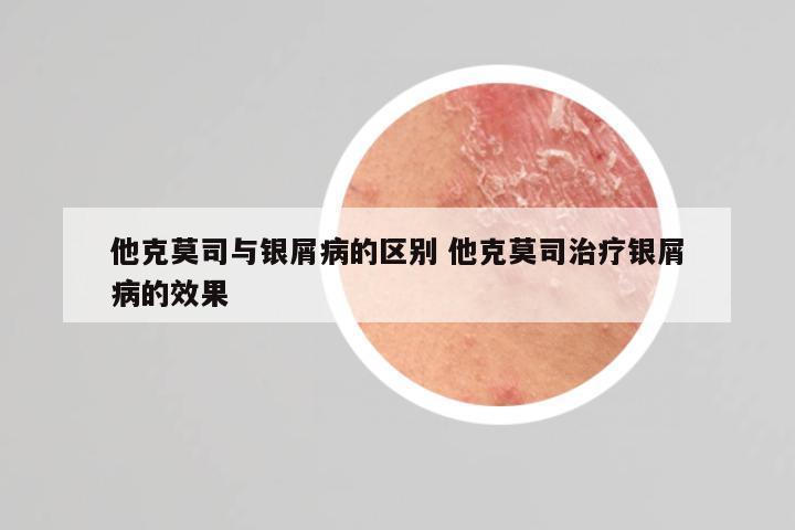 他克莫司与银屑病的区别 他克莫司治疗银屑病的效果