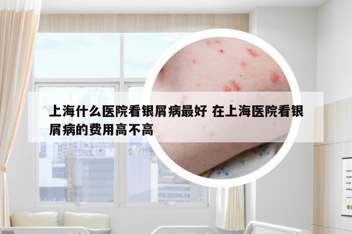 上海什么医院看银屑病最好 在上海医院看银屑病的费用高不高